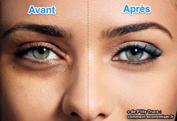 comment traiter les poches sous les yeux naturellement