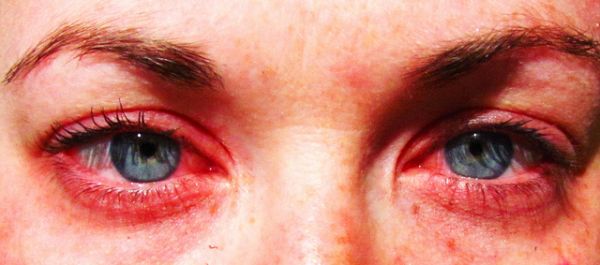 comment avoir moins les yeux rouges