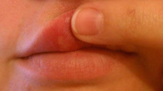 herpes on mouth images #10